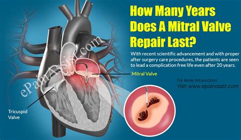 How Many Years Does A Mitral Valve Repair Last