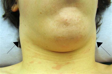 Enlarged Lymph Nodes The Causes Of Lymphadenopathy