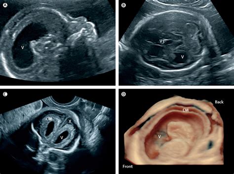 Ultrasound Imaging For Identification Of Cerebral Damage In Congenital