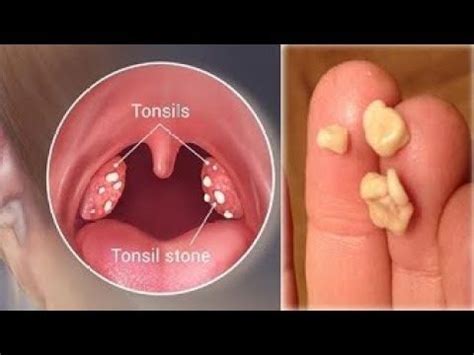 Learn more about what to look for if you're concerned you might feel like food is sticking in your throat. Swollen Tonsils Diagnosis Sore Cure Quick For Cough Throat ...