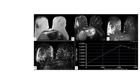 Breast Lesion Characterisation With Diffusion Weighted Imaging Versus