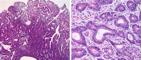 Gastric Carcinoma Morphologic Classifications And Molecular Changes