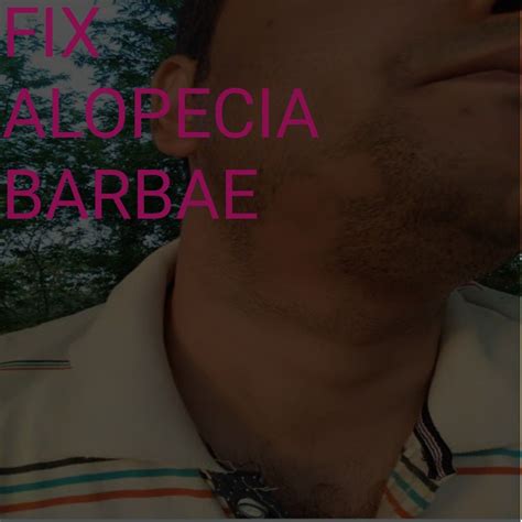 How To Treat Alopecia Barbae Baldspots In Beard In 2021 Alopecia