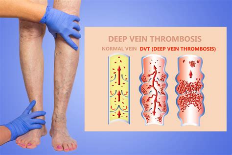 Dvt And Blood Clots In Your Legs Maryland Vascular Specialists