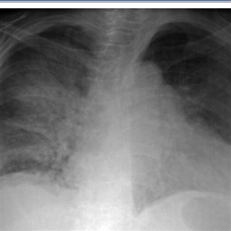 Chest X Ray Upon Hospitalization Showing Opacity In The Lung Fields