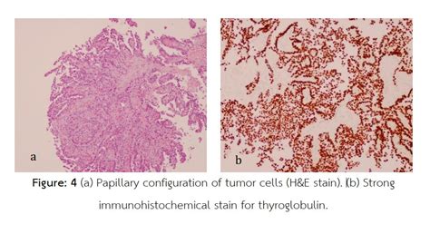 Unusual Presentation Of Papillary Thyroid Carcinoma Nasopharyngeal