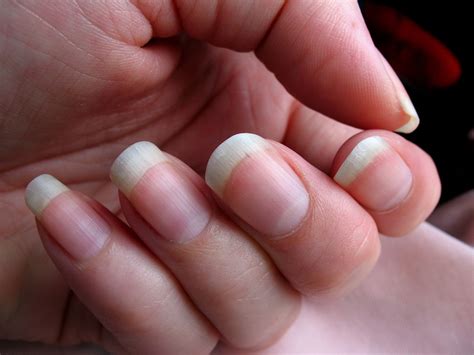 10 Ways How Your Finger Nail Says About Your Health