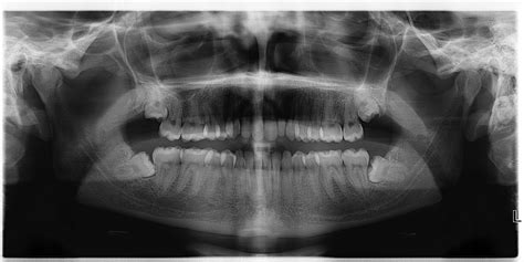 Wisdom Teeth Advance Cosmetic And General Dentistry