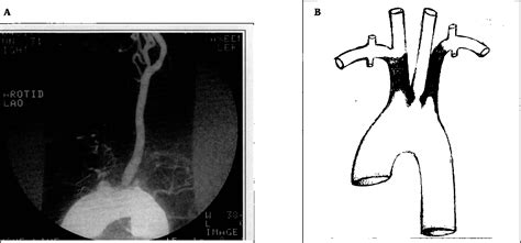 Figure 1 From Bilateral Subclavian Steal Syndrome Through Different