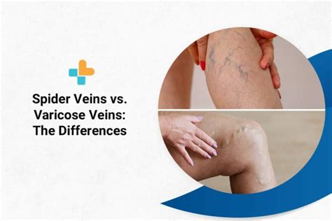 Spider Veins Vs Varicose Veins The Differences