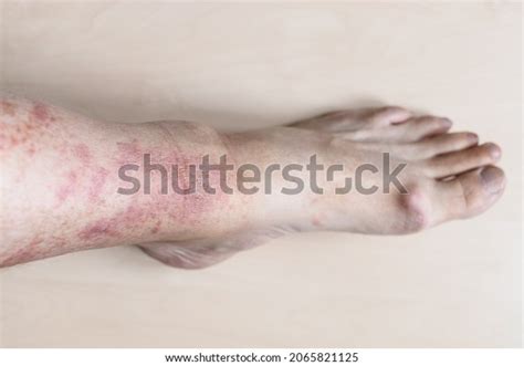 Sample Allergic Contact Dermatitis Male Shin Stock Photo 2065821125