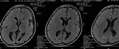 Dr Balaji Anvekars Neuroradiology Cases Hypoxic Ischemic