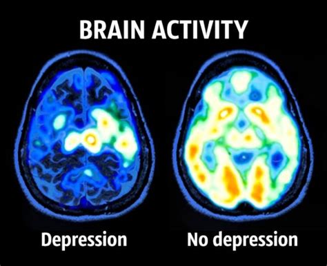 Depression In The Brain In Light Ment