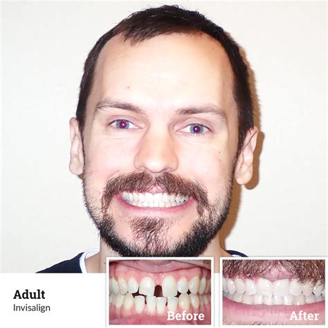 Before And After Braces And Invisalign Wiewiora And Dunn Ortho