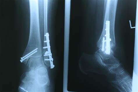 Orif Surgery For Ankles Texas Orthopedic And Spine Associates
