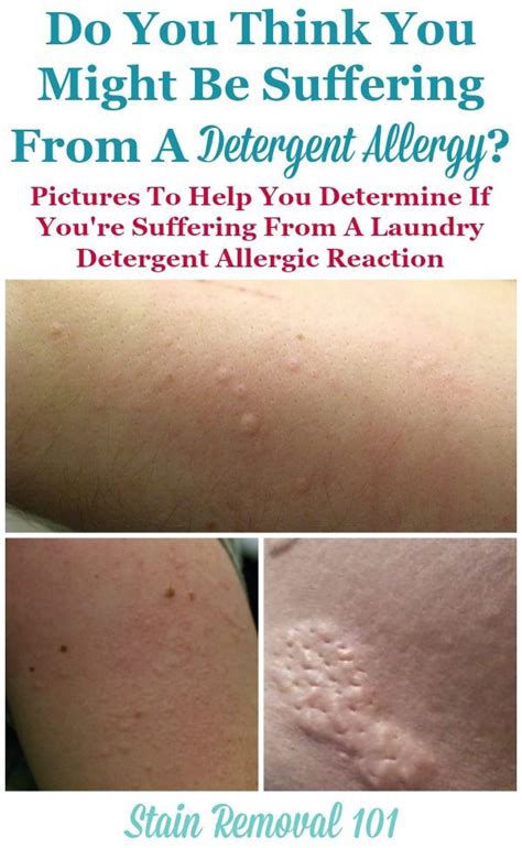 Detergent Allergy Pictures Find Out If Youre Allergic To Laundry Detergent Laundry Detergent