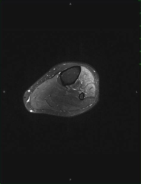 Common Peroneal Neuroma Musculoskeletal Case Studies Ctisus Ct Scanning