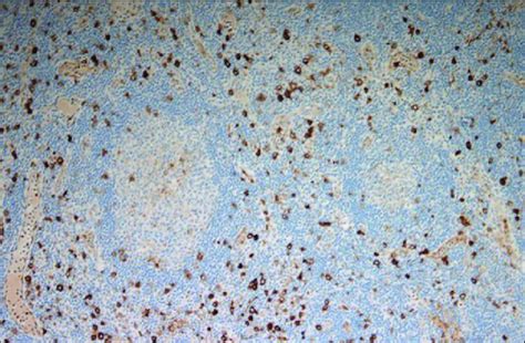 Immunohistochemical Staining For Cd30 And Hematoxylin Stain In The