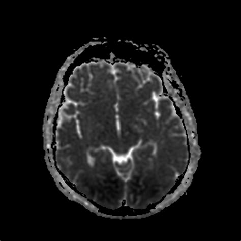 Hypoxic Ischaemic Brain Injury Image
