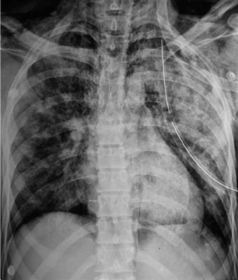 Chest Radiograph Shows Massive Subcutaneous Emphysema And Consolidation