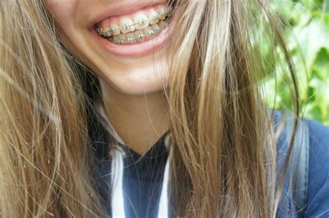 Pin By Robert Dubray On Braces Braces Girls Perfect Teeth Beautiful Smile