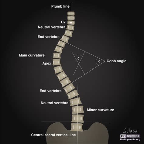 Idiopathic Scoliosis Wikimsk