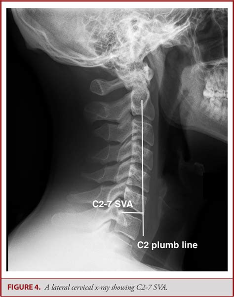 Figure 6 From Cervical Spine Deformity—part 1 Biomechanics