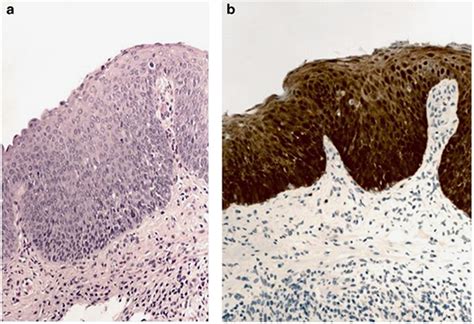 Anal Neoplasia In Inflammatory Bowel Disease Is Associated W Clinical And Translational
