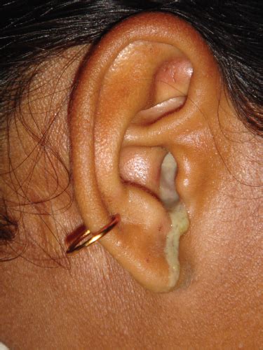 ear drainage