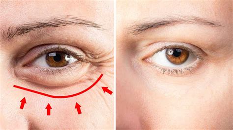 Top 77 Causes Of Eye Bags Induhocakina
