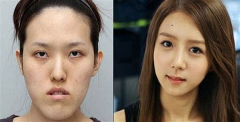 Before And After South Korean Eye Surgery Seoul Touchups Favourites