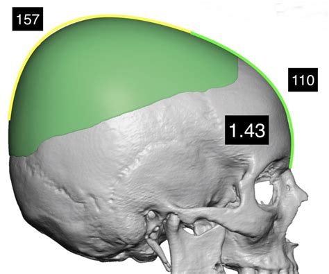 Female Skull Side Profile Postop Dr Barry Eppley Indianapolis Explore