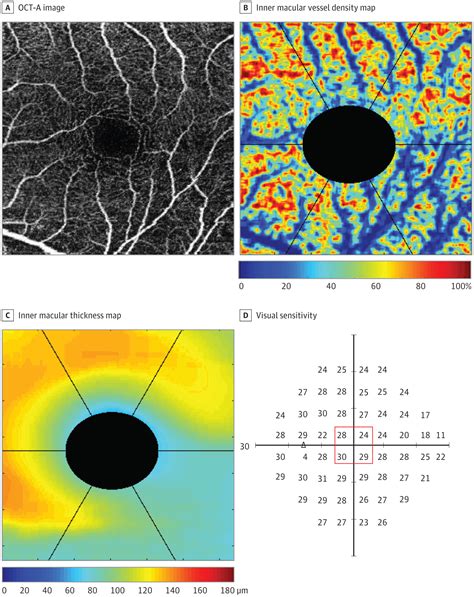 optical coherence tomography angiography compared with optical coherence tomography macular