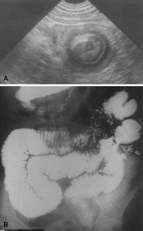 Case 1 A Transverse Ultrasound Scan Of Intussusception Demonstrates A