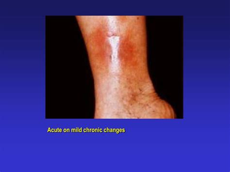 Ppt Venous Stasis Dermatitis Powerpoint Presentation Free Download