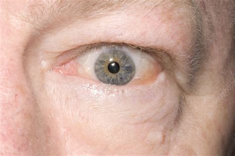 Swollen Eye In Thyrotoxicosis Stock Image M2700366 Science Photo