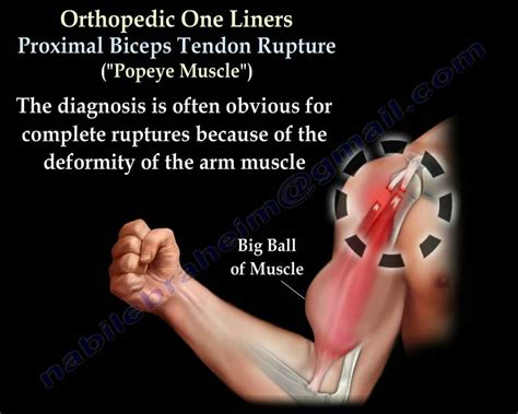 Biceps Tendon Rupture Popeye Muscle Everything You Need To Know Dr