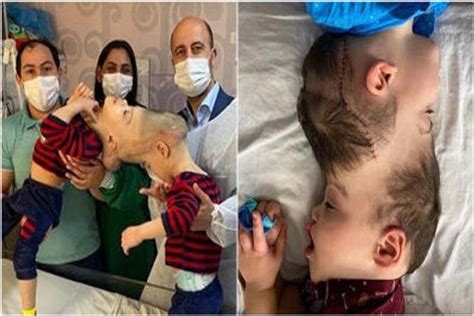 Brazilian Conjoined Twins With Fused Brains Successfully Separated By