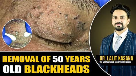 Removal Of 50 Years Old Blackheads Ii Dr Lalit Kasanas Youtube