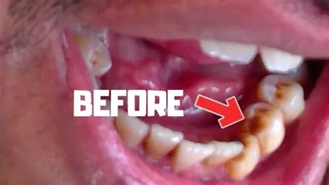 How To Remove Brown Stains On Teeth Instantly