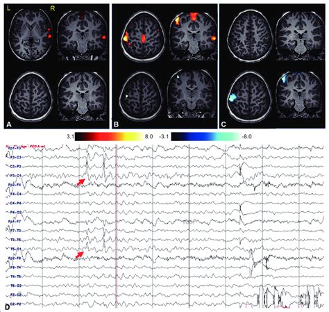 Hemodynamic Response Patterns In A Patient With Childhood Epilepsy With