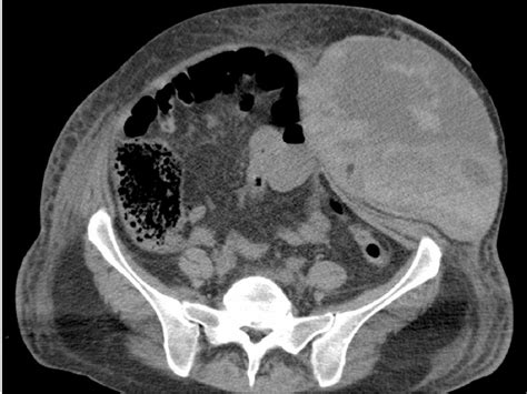Imaging Of The Anterior Abdominal Wall A Radiological Review