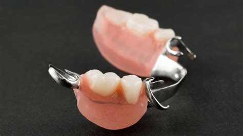 Removable Partial Denture For One Tooth
