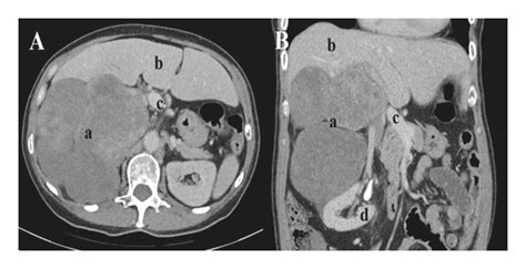 Ct Scan Of Retroperitoneal Mass A Axial Slice Of Contrast Enhanced