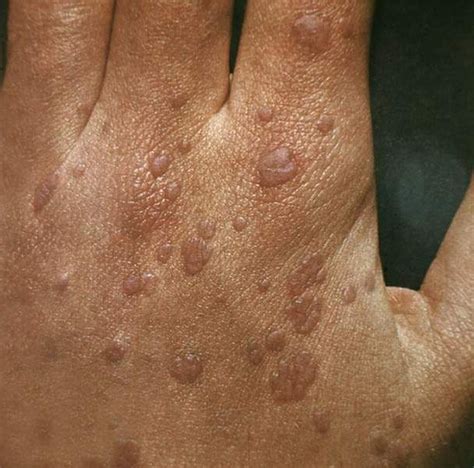 Flat Warts Symptoms Causes And Ways Of Treatment Med Warts