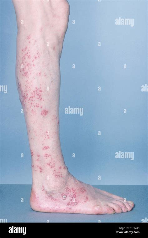 Shingles Lesions On Foot Hi Res Stock Photography And Images Alamy