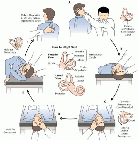 Epley Maneuver Epley Maneuver For Right Sided Posterior Semicircular