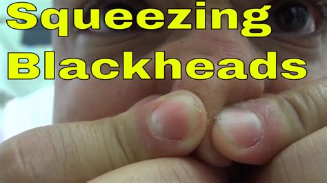 Diy Squeezing Blackheads Out Of My Nose Quick And Easy Youtube