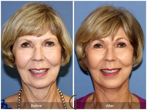 Neck Lift Before And After Photos From Dr Kevin Sadati