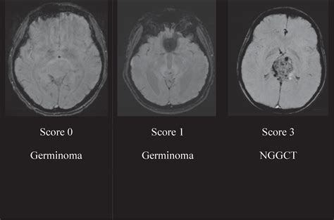 Differentiation Between Germinoma And Other Pineal Region Tumors Using